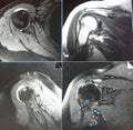 Mri shoulder pathology