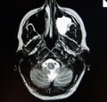 Mri of sinusitis