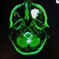 Mri of sinusitis