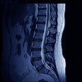 MRI Spine Royalty Free Stock Photo