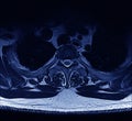 MRI Spine Royalty Free Stock Photo