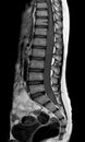 MRI spine showing mass at distal cord and conus medullaris, with tumor seedings at lower spinal canal. The mass appear hypersignal