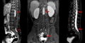 MRI spine showing mass at distal cord and conus medullaris, with tumor seedings at lower spinal canal. The mass appear hypersignal