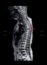 MRI T spine.History:Case back pain radiate to buttock and legs finding intradural and extramedullary mass T6 spine on arrow