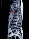 MRI Thoracic lumbar spine show moderate pathological compression fracture of T12 level Royalty Free Stock Photo