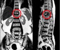 MRI Thoracic lumbar spine show moderate pathological compression fracture of T12 level Royalty Free Stock Photo