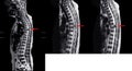 MRI Thorac spine.History:Case back pain radiate to buttock and legs finding intradural and extramedullary mass T6 spine on arrow