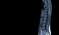 MRI of thoracic spine Moderate pathologic compression fracture of T9 vertebral body with paravertebral abscess at T9-10