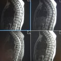 Mri of thoracic spine pathology