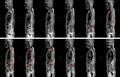 MRI OF THORACOLUMBAR SPINE IMPRESSION:  Moderate pathological compression of T11 and L2 levels with enhancing multiple marrow Royalty Free Stock Photo