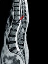 MRI OF THORACOLUMBAR SPINE Moderate to severe compression fracture of L1 vertebra