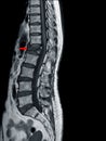 MRI OF THORACOLUMBAR SPINE Moderate to severe compression fracture of L1 vertebra Royalty Free Stock Photo