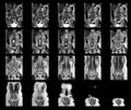 MRI OF THE THORACOLUMBAR SPINE a patient who has moderate to severe compression fractures of T11 and L2 levels with abnormal