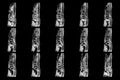 MRI OF THE THORACOLUMBAR SPINE a patient who has moderate to severe compression fractures of T11 and L2 levels with abnormal