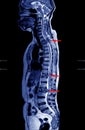 MRI OF THORACOLUMBAR SPINE There is decreased lumbosacral lordosis without spondylolisthesis Royalty Free Stock Photo