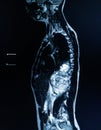 MRI OF THE THORACOLUMBAR SPINE: a 30 year old female pressented with retroperitoneal mass,to rule out TB spine.Medical healthcare