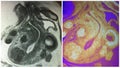 Mri uterine endometrial polyps menopausal collage