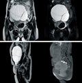 MRI OF WHOLE ABDOMEN HISTORY: A 67-year-old woman, presented with huge complex cystic lesion in abdomen