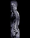 MRI whole spine screening for diagnosis spinal cord compression Royalty Free Stock Photo