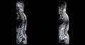 MRI whole spine screening for diagnosis spinal cord compression