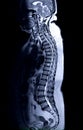 MRI whole spine screening sagittal T2.