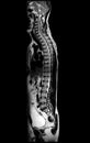 MRI of whole spine  T2W sagittal  plane Royalty Free Stock Photo