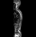 MRI of whole spine T2W sagittal plane. Royalty Free Stock Photo