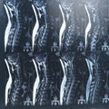 MRI xray film scan of sacro-lumbar spines of a patient with chronic back pain