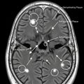 MS MRI: visible brain lesions Royalty Free Stock Photo