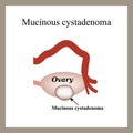 Mucinous cyst on the ovary. Cystadenoma. Ovary.