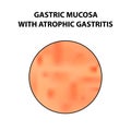 Mucous stomach with atrophic gastritis. Infographics. Vector illustration on isolated background
