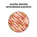 Mucous stomach with erosive gastritis. Infographics. Vector illustration on isolated background