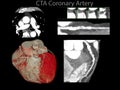 Muiti view of CTA Coronary artery 2D and 3D rendering image.