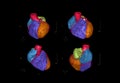 Multi view of CTA Coronary artery 3D rendering image.