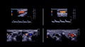 Ultrasound doppler of artery vessel.