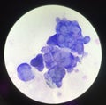 Multinucleated cell in Tzanck test