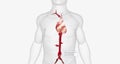 Multiple aneurysms may form in descending aorta and branches