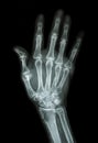 Multiple fracture at index,little finger,metacarpal bone