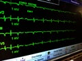 Multiple Green EKG Tracings on ICU Monitor