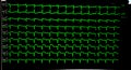 Multiple Green EKG Tracings on ICU Monitor