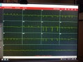 Multiple Green EKG Tracings on telemetry Monitor Royalty Free Stock Photo