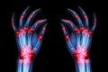 Multiple joint arthritis both adult hands ( Gout , Rheumatoid ) on black background