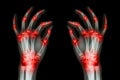 Multiple joint arthritis both adult hands ( Gout , Rheumatoid ) on black background