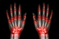 Multiple joint arthritis both hands ( Gout , Rheumatoid ) on black background