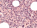 Multiple myeloma in the bone marrow. Histology. Royalty Free Stock Photo