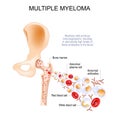 Multiple myeloma. Cross section of a Bones of the hip joint, Pelvis and femur. Royalty Free Stock Photo