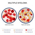 Multiple myeloma. Close-up of Healthy bone marrow and Plasma cell myeloma