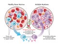 Multiple Myeloma medical illustration