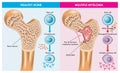 Multiple myeloma