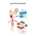 Multiple myeloma. plasma cell myeloma Royalty Free Stock Photo